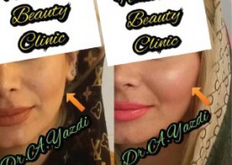 انتقال چربی